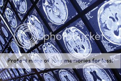 brain Brain plaques are believed to play a major role in the development of Alzheimer’s disease.