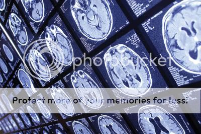 senior brain In the early 1960s, scientists determined that the loss of brain cells was causing Parkinson’s.