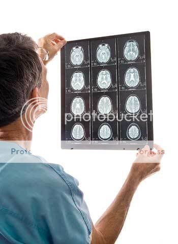 MRI Doctors can use a magnetic resonance image (MRI) to detect signs of stroke.